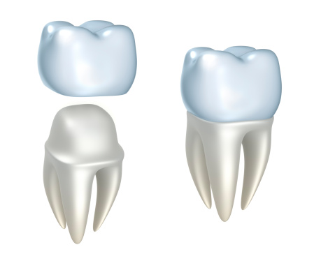 A dental crown above tooth and tooth with dental crown placed