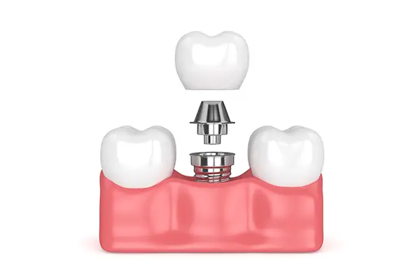 A close-up diagram of an implant screw, abutment, and crown being placed in a row of teeth, demonstrating implant installation.